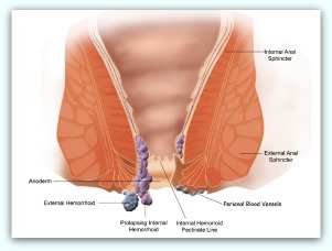 home remedies for hemorrhoids