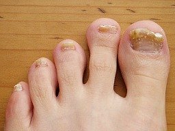 Nail fungus remedies